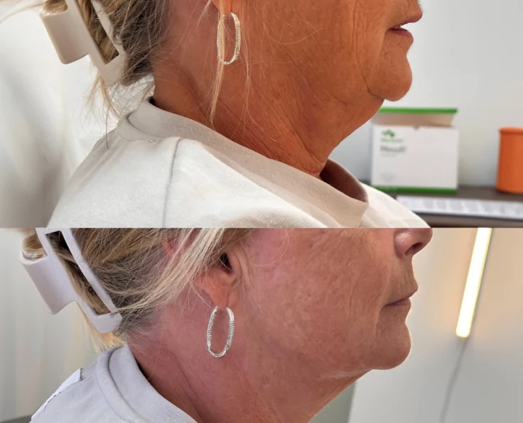 hifu-huduppstramning