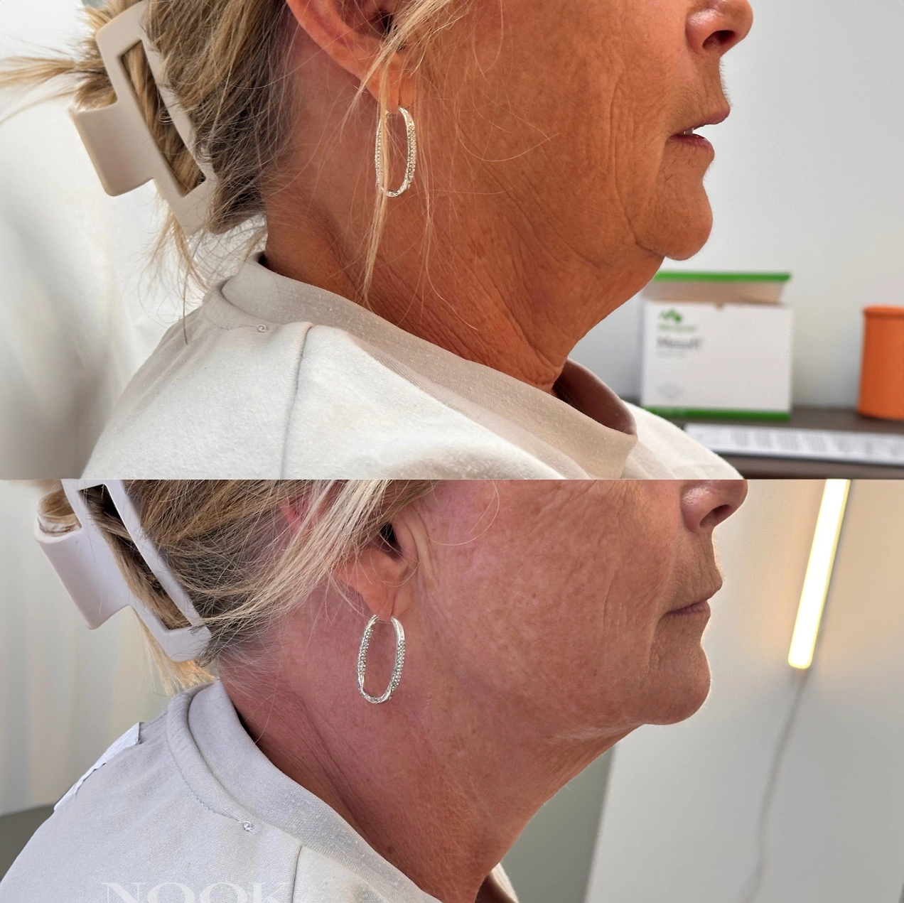 hifu-huduppstramning