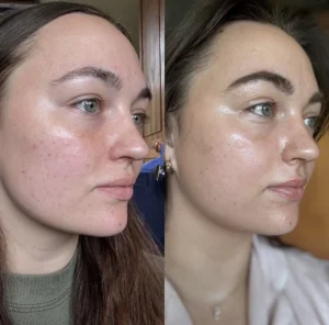 biorepeel-kemisk-peeling-nook-laser-studio