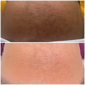 melasma-behandling-nook-malmö