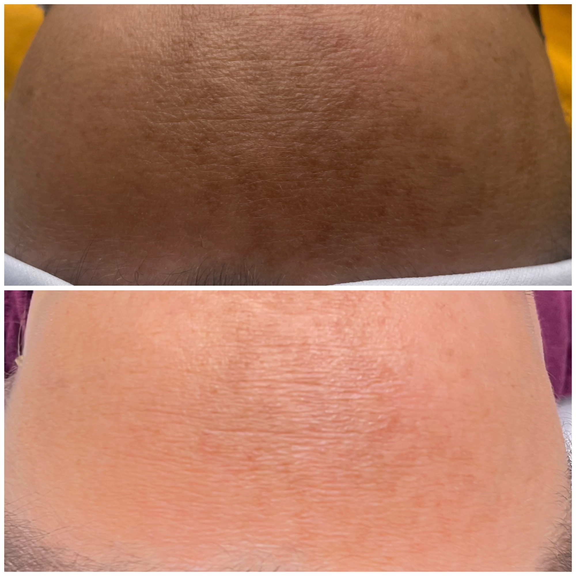 melasma-behandling-nook-malmö