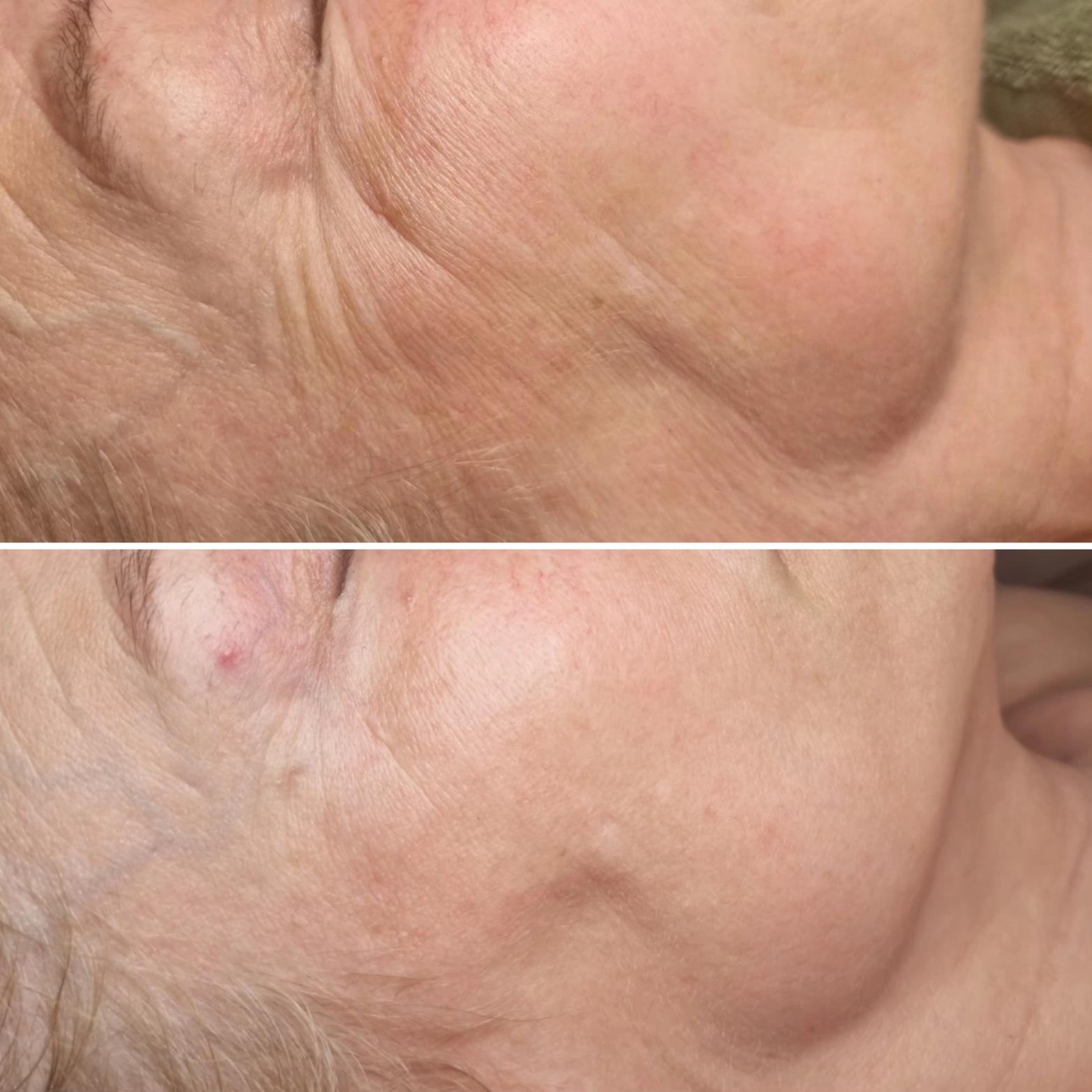 nook-laser-studio-hudslipning