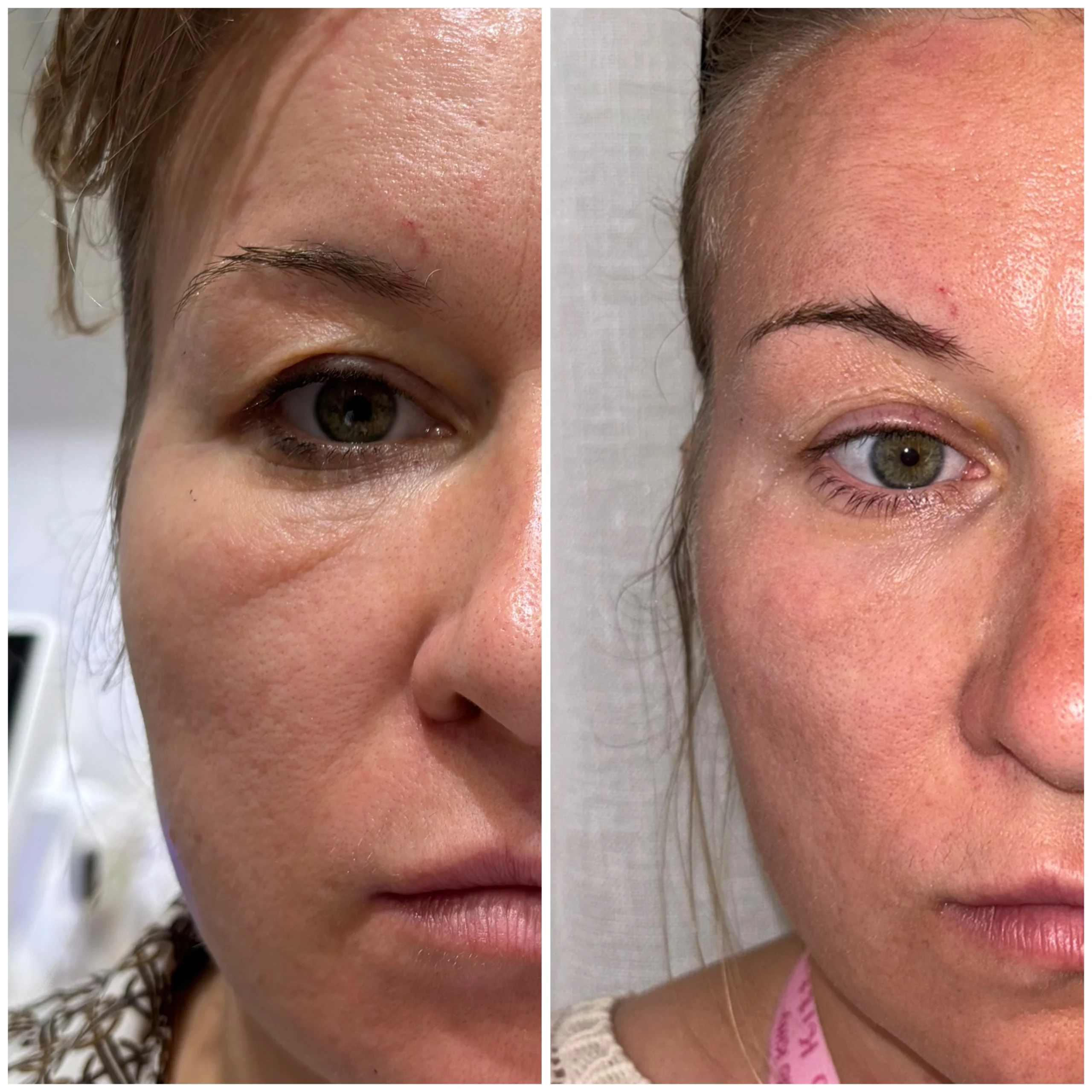 hifu-huduppstramning