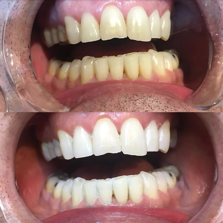 tandblekning-malmökopiera